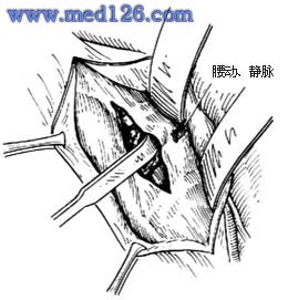 腰骶段脊椎结核手术:病灶清除术