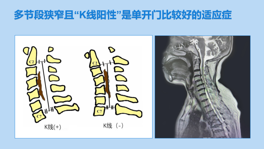 如何做好颈后路单开门椎管扩大成形术？