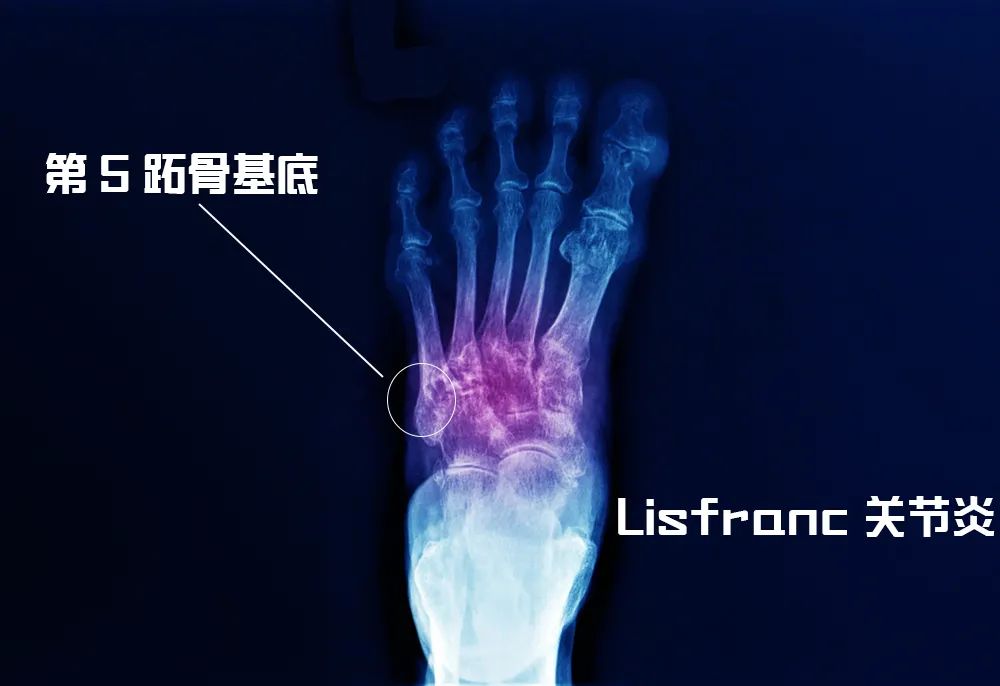 急诊突然来了一个第 5 跖骨基底骨折患者，手术还是保守？你怎么选？