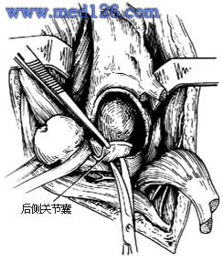 髋关节结核手术:髋关节结核病灶清除术