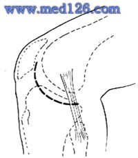 半月板手术:外侧半月板切除术