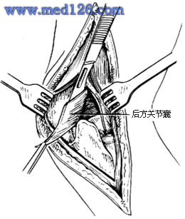 肘关节切除手术