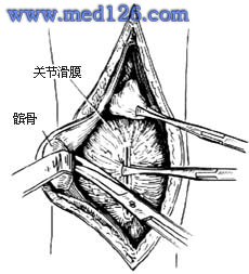 膝关节结核病灶手术:清除术